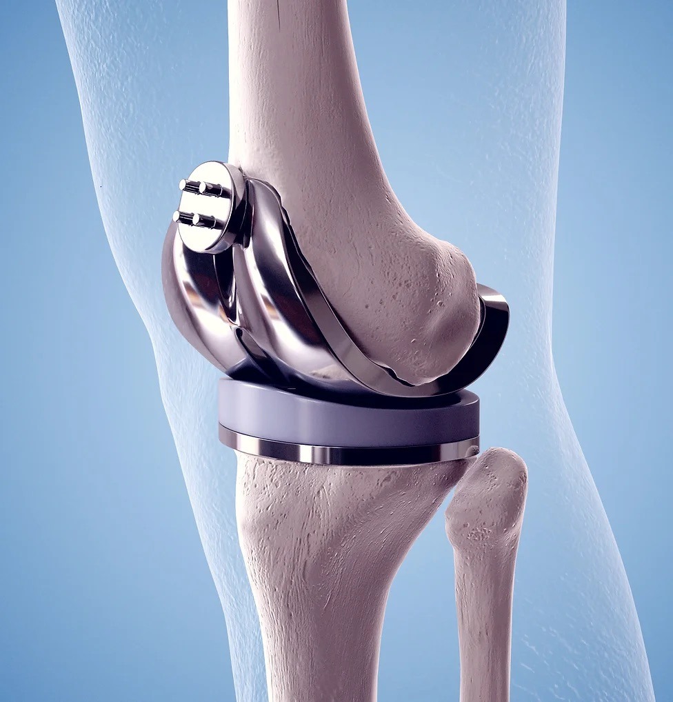 Total Knee Replacement (UAE)