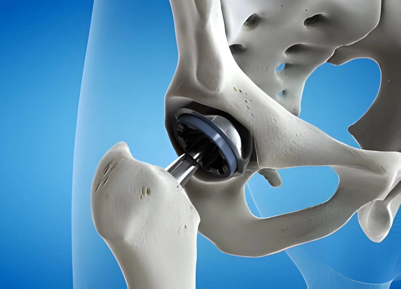 Total Hip Replacement (UAE)