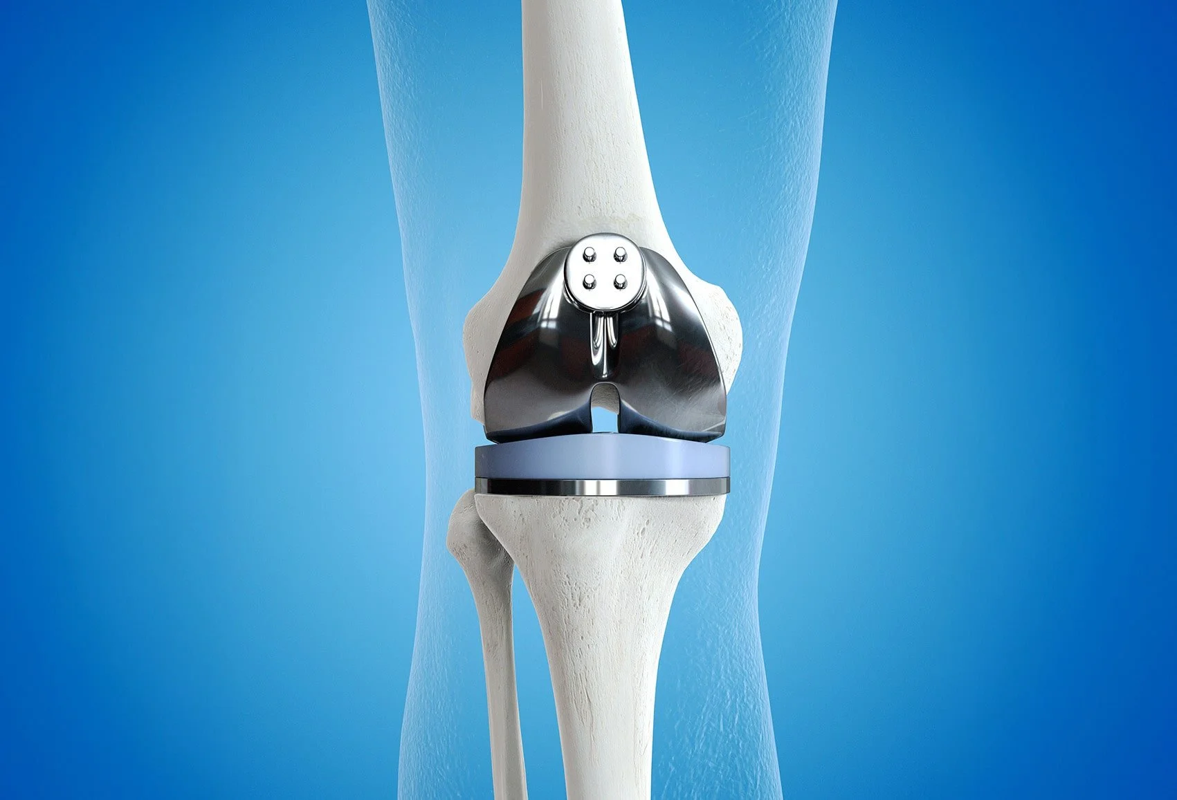 Fracture Fixation / Trauma Surgery (UAE)